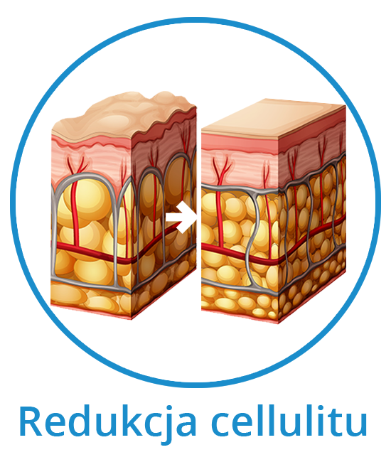 cellulite-reduction